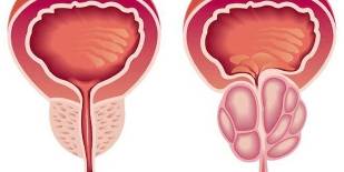 prostatitis