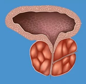 The characteristic symptoms of prostatitis