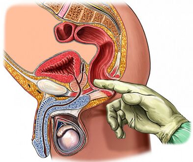Prostate finger exam