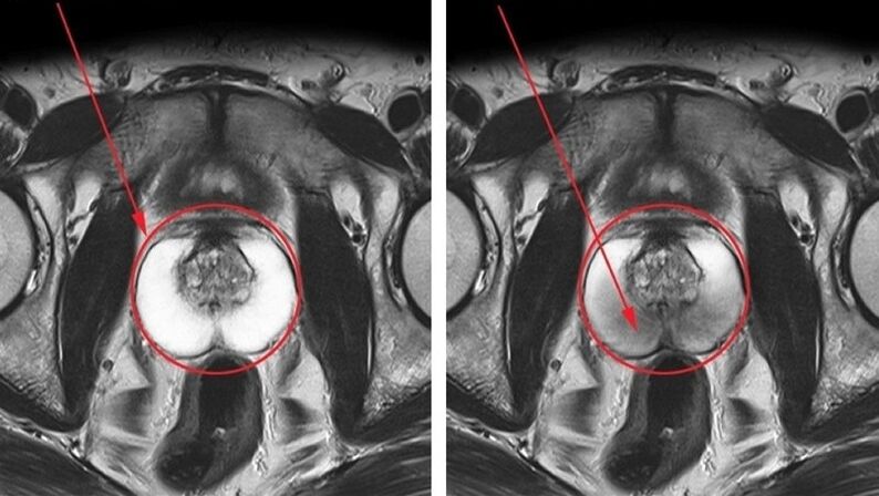 a healthy, inflamed prostate with chronic prostatitis