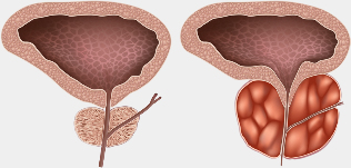 and healthy patient the gland